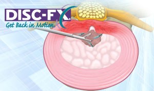 Disc-FX® minimally invasive spine surgery