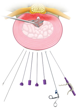 Minimally Invasive Discectomy & Microdiscectomy 