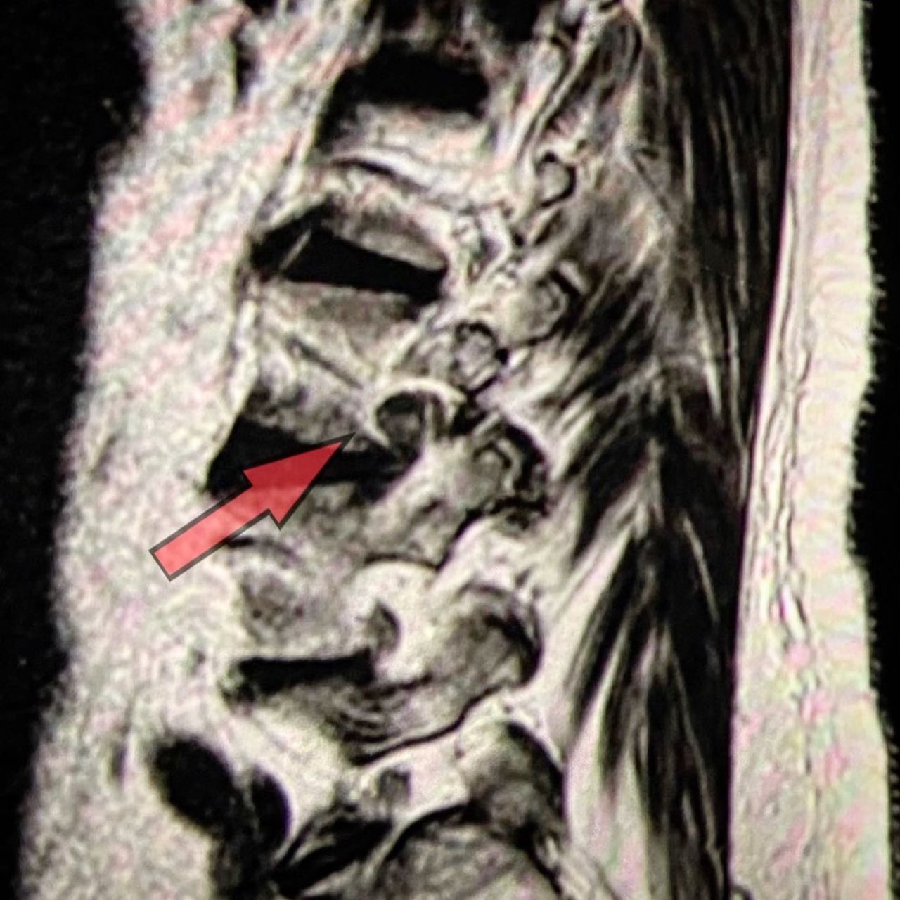 spine lumbar with red arrow
